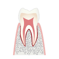 超初期の虫歯