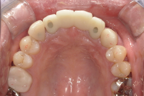 歯の裏側写真