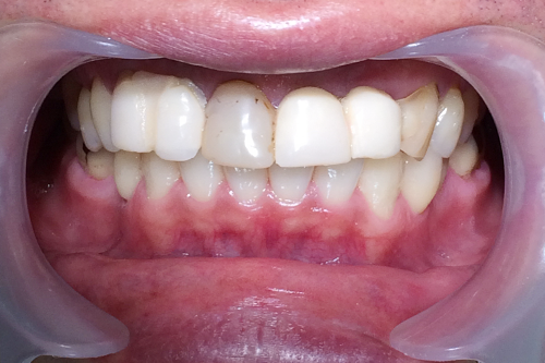 歯の表面写真