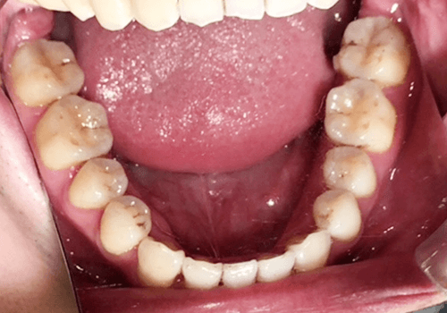 治療後の歯