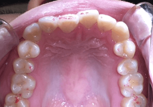 治療前の歯