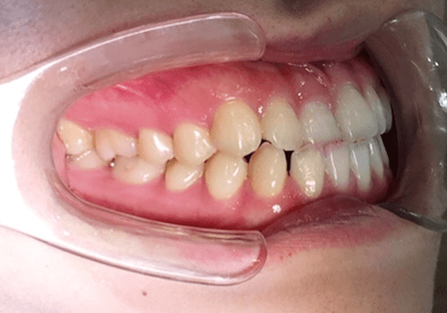 治療前の歯