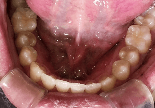 治療後の歯